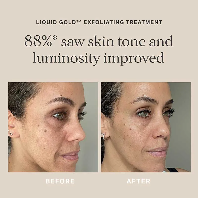 Alpha-H Liquid Gold Exfoliating Treatment with 5% Glycolic Acid